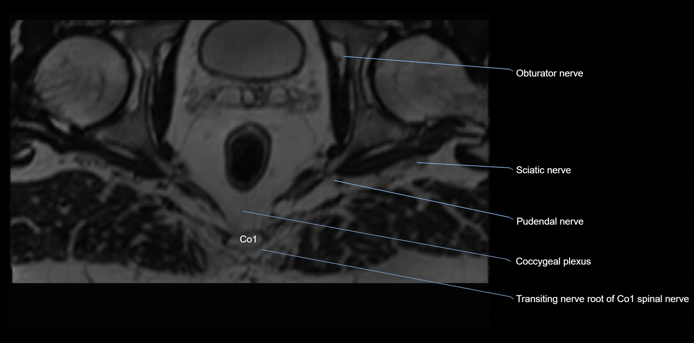 MR lumbosacral plexus axial cross sectional anatomy 3T  radiology  image-img-1008001-00125.webp